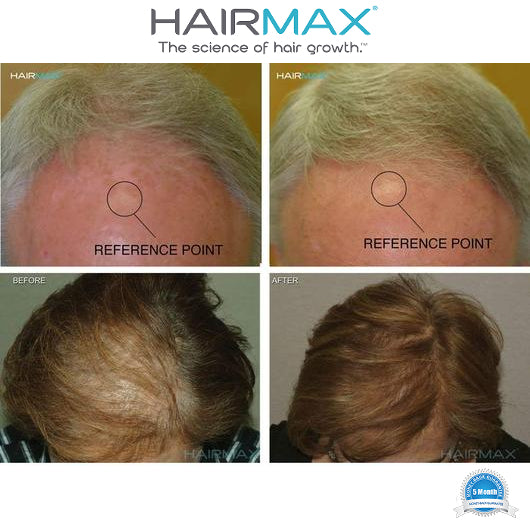 REGROW MD LASER 272 hairmax.co.uk